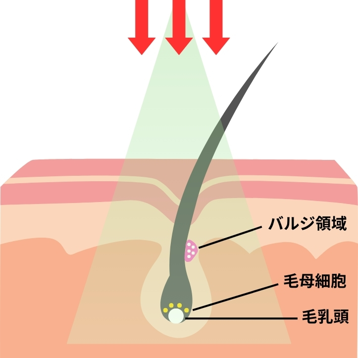 熱破壊式